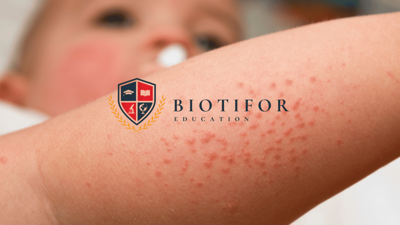 Biang Keringat pada Bayi: Gejala, Penyebab, dan Cara Mengatasi - Biotifor