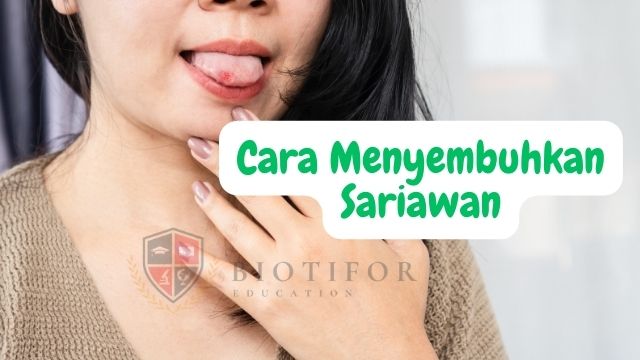 Cara Menyembuhkan Sariawan