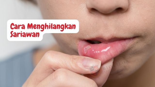 Cara Menghilangkan Sariawan