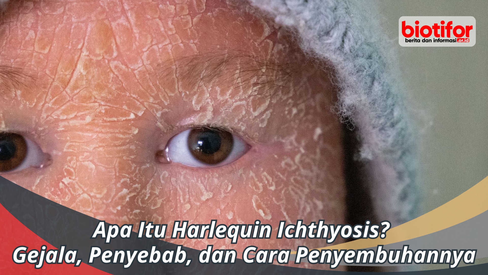 Apa Itu Harlequin Ichthyosis? Gejala, Penyebab, dan Obatnya