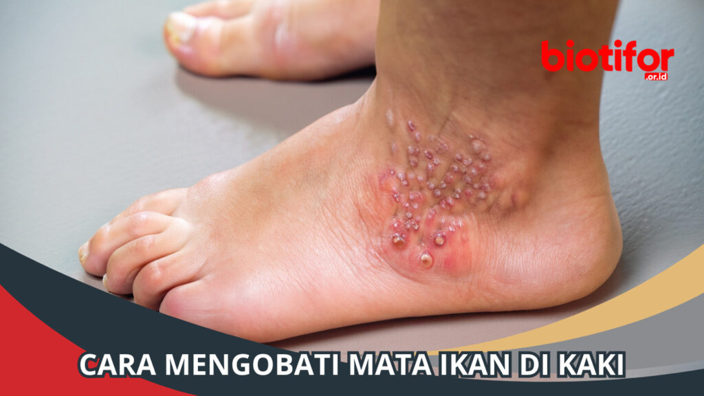 Mata Ikan di Kaki: Penyebab, Pengobatan, dan Pencegahan - Biotifor