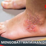 Mata Ikan di Kaki