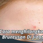 Penyebab Bruntusan pada Jidat