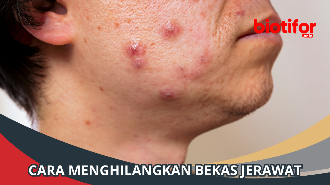 Cara Menghilangkan Bekas Jerawat: Cantik Tanpa Bekas Jerawat