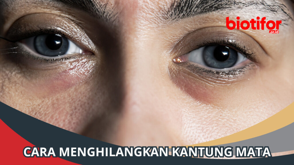 Cara Menghilangkan Kantung Mata Agar Tampil Segar dan Ceria Biotifor