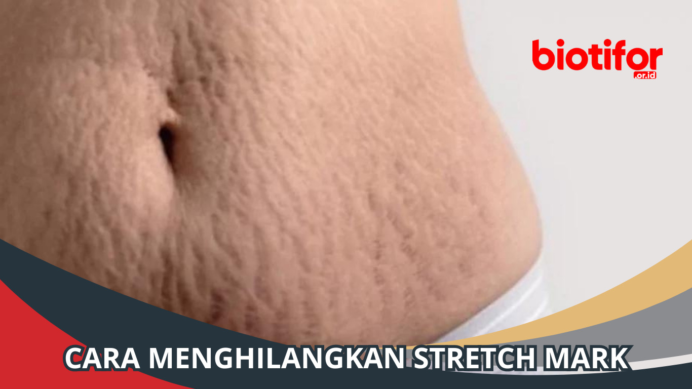 Cara Menghilangkan Stretch Mark: Tips untuk Kulit Lebih Halus