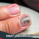 Obat Jamur Kuku