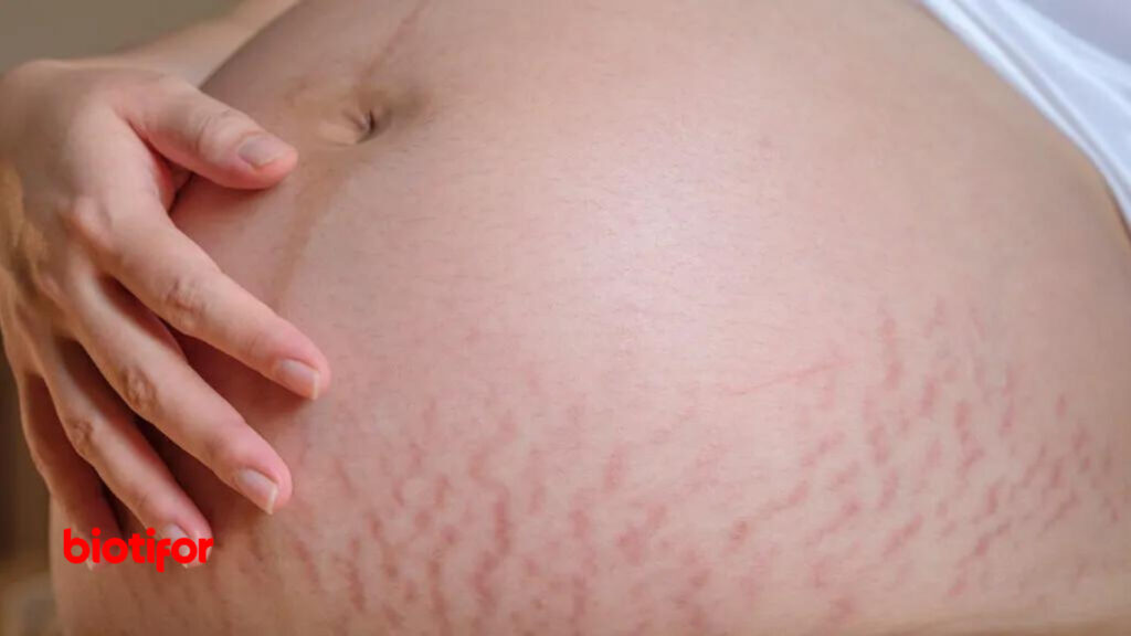 Cara Menghilangkan Stretch Mark