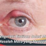 Cara Mengatasi Bintitan: Solusi Mudah untuk Masalah Mata yang Mengganggu