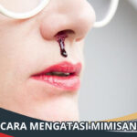 Cara Mengatasi Mimisan