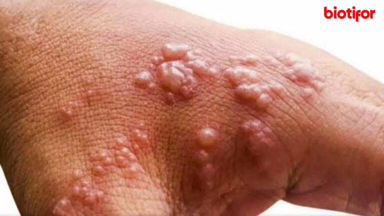 Macam Macam Cacar Beserta Gambarnya