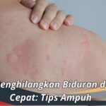 Cara Menghilangkan Biduran dengan Cepat: Tips Ampuh