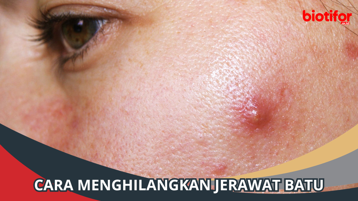 Cara Menghilangkan Jerawat Batu, Jika Salah Penanganan Bisa Bahaya!