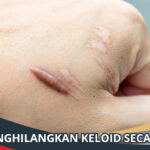 Cara Menghilangkan Keloid