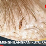 Cara Menghilangkan Kutu Rambut