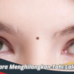 Cara Menghilangkan Tahi Lalat