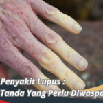 Gejala Penyakit Lupus
