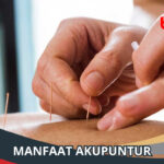 Manfaat Akupuntur