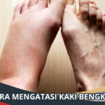 Cara Mengatasi Kaki Bengkak