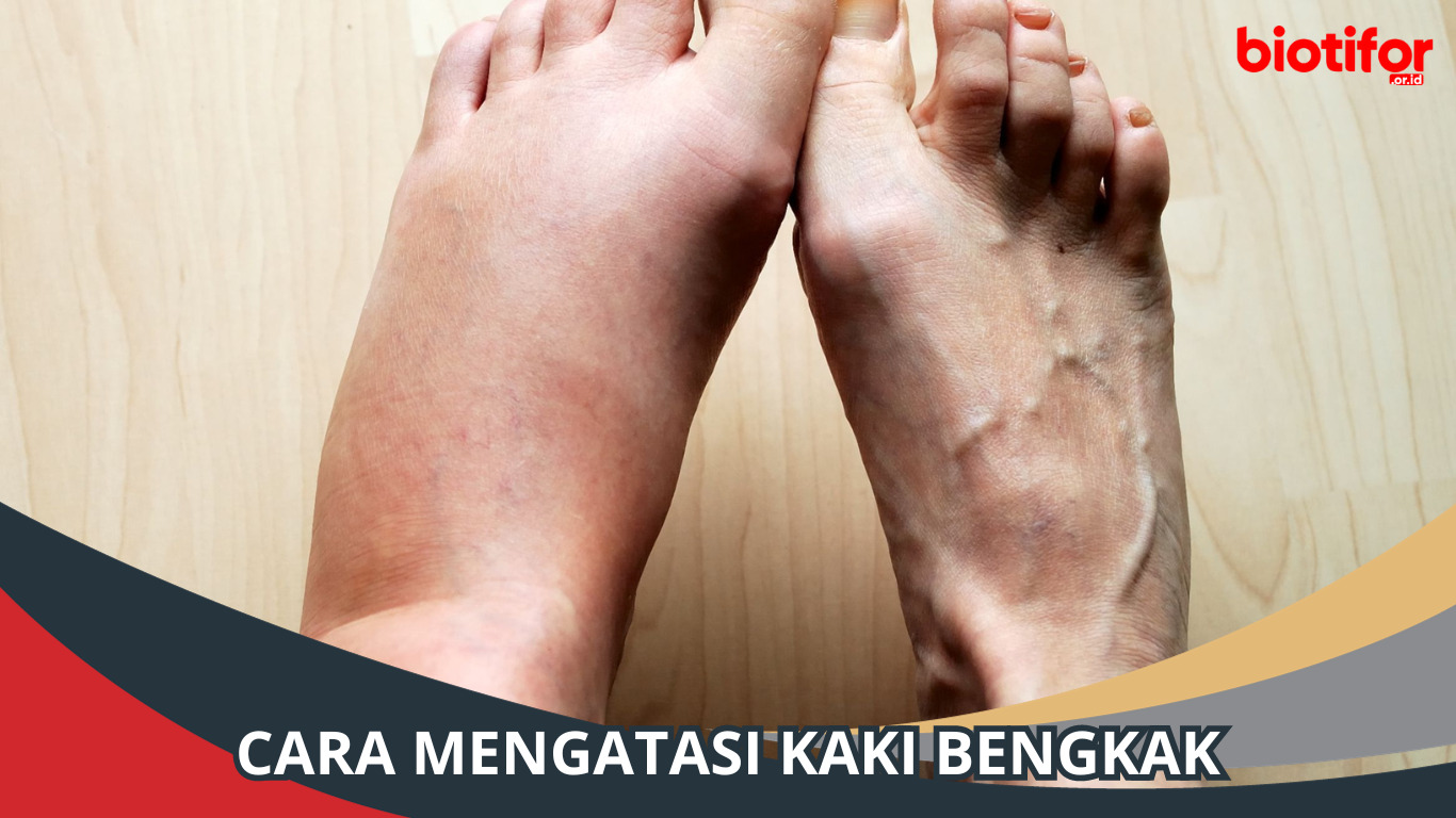 Cara Mengatasi Kaki Bengkak dan Penyebabnya, Simak
