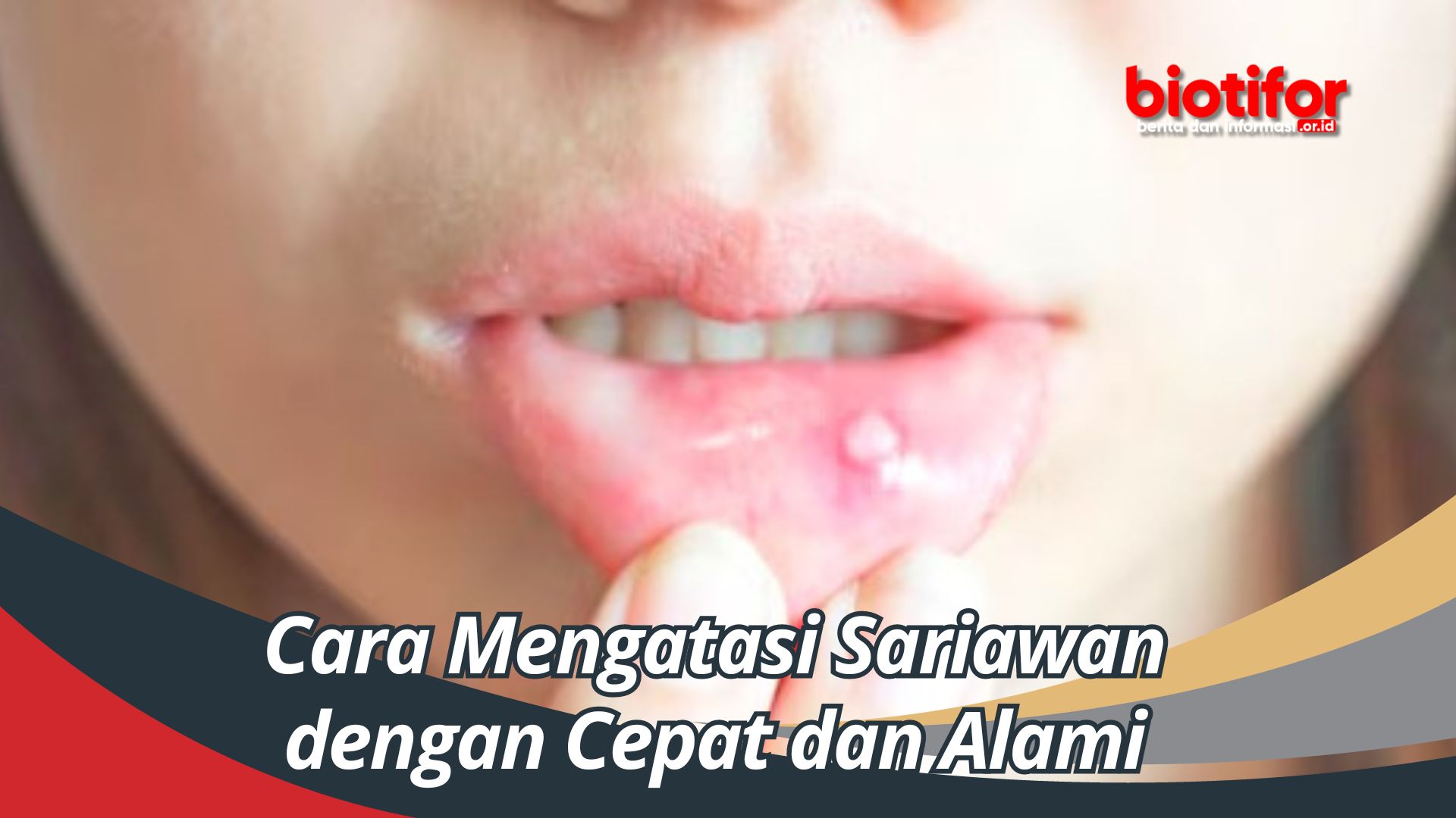 Cara Mengatasi Sariawan dengan Cepat dan Alami