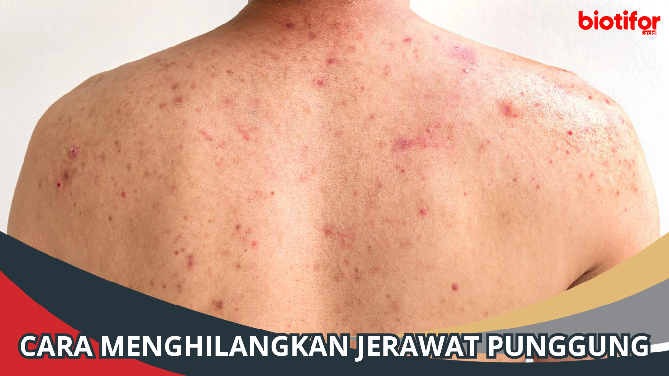 Cara Menghilangkan Jerawat Punggung dan Bekasnya, Punggung Jadi Indah!