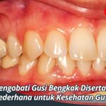 Cara Mengobati Gusi Bengkak Disertai Nyeri, Solusi Sederhana untuk Kesehatan Gusi Anda