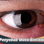 Penyebab Mata Bintitan