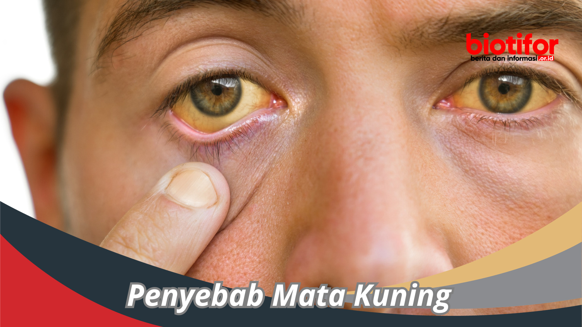 Apa Saja Penyebab Mata Kuning ? Ini Dia Penyebab Utamanya