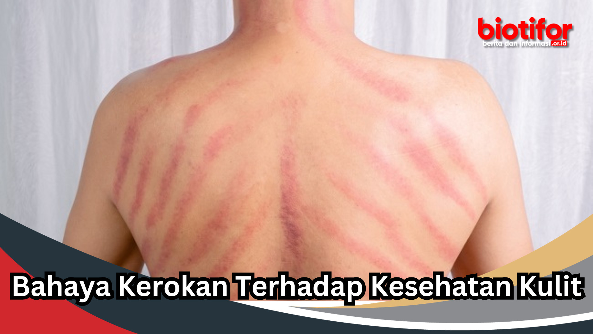 Bahaya Kerokan Terhadap Kesehatan Kulit