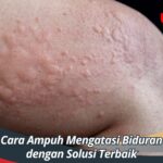 Cara Ampuh Mengatasi Biduran dengan Solusi Terbaik