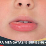 Cara Mengatasi Bibir Bengkak