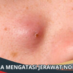 Cara Mengatasi Jerawat Nodul