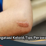 Cara Mengatasi Keloid