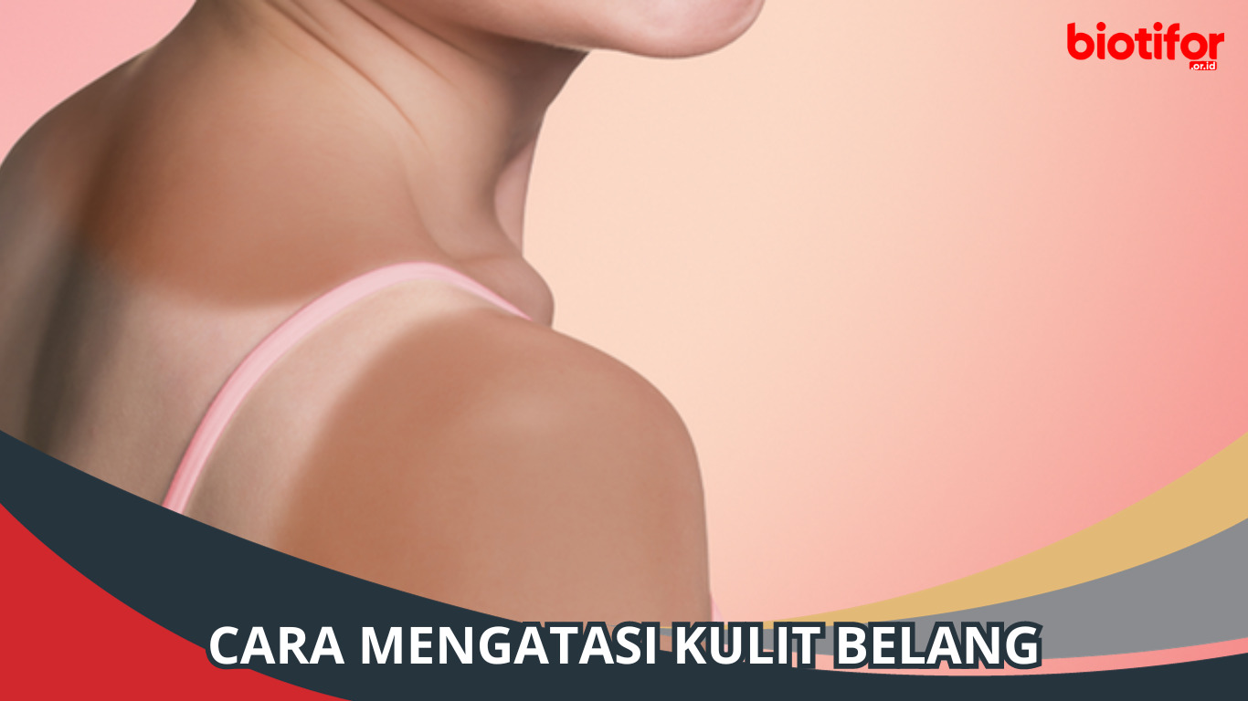 Cara Mengatasi Kulit Belang dengan Mudah