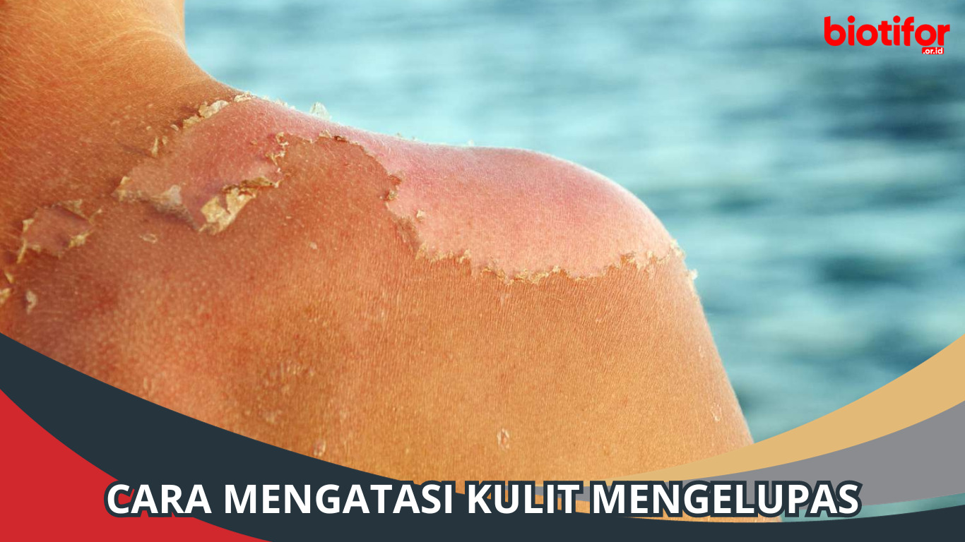 Cara Mengatasi Kulit Mengelupas: Tips dan Perawatan yang Efektif