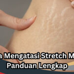 Cara Mengatasi Stretch Mark