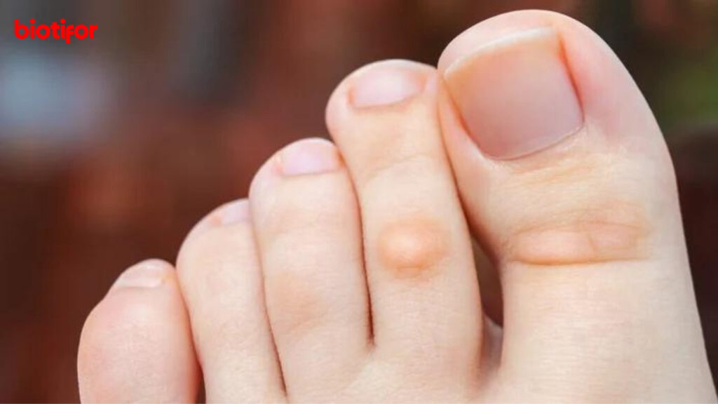 Cara Menghilangkan Kapalan di Kaki Secara Alami