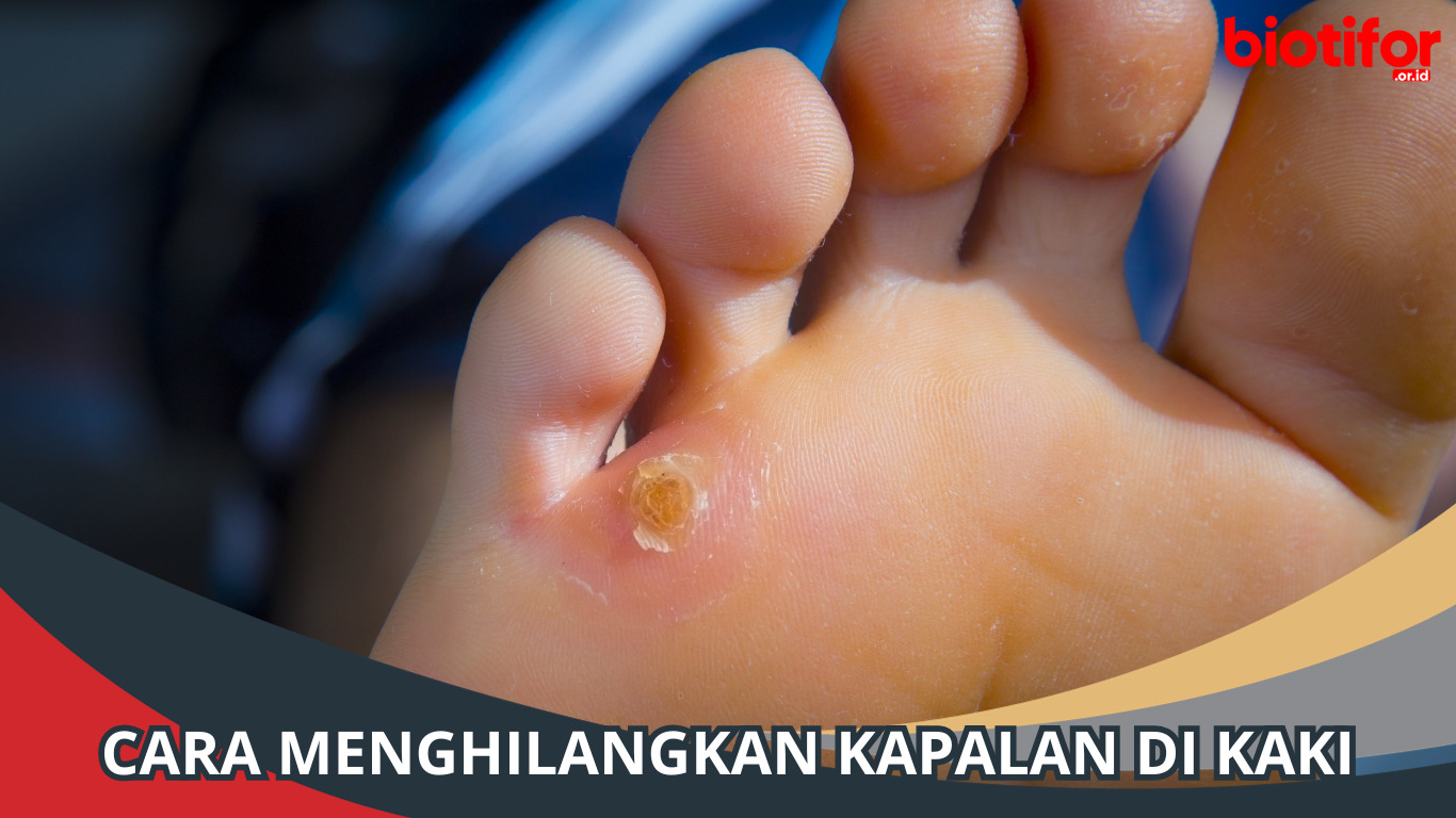Cara Menghilangkan Kapalan di Kaki dengan Bahan Alami