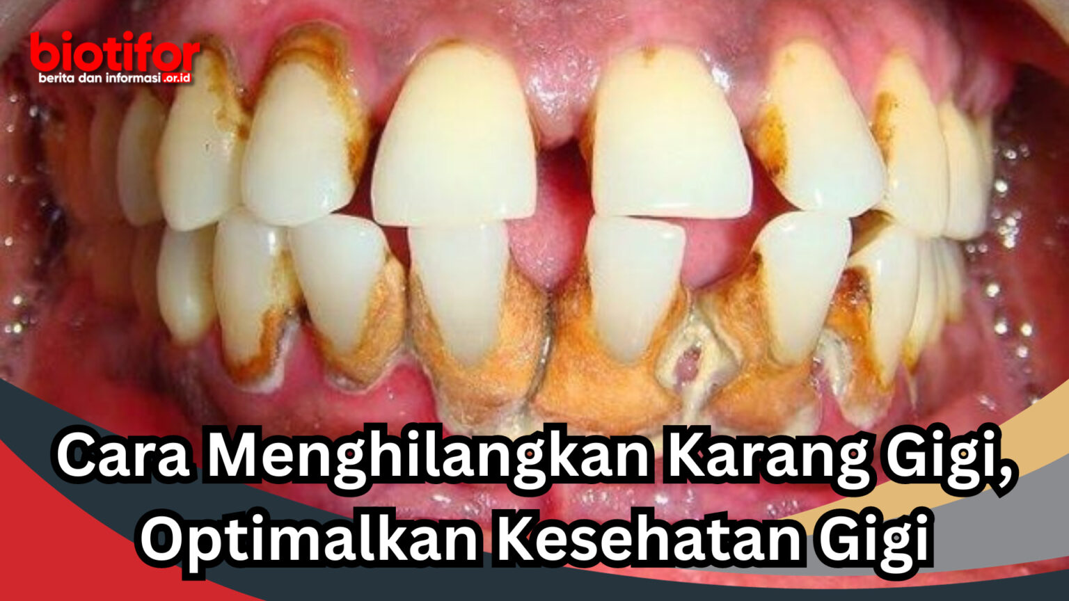 Cara Menghilangkan Karang Gigi, Optimalkan Kesehatan Gigi Biotifor