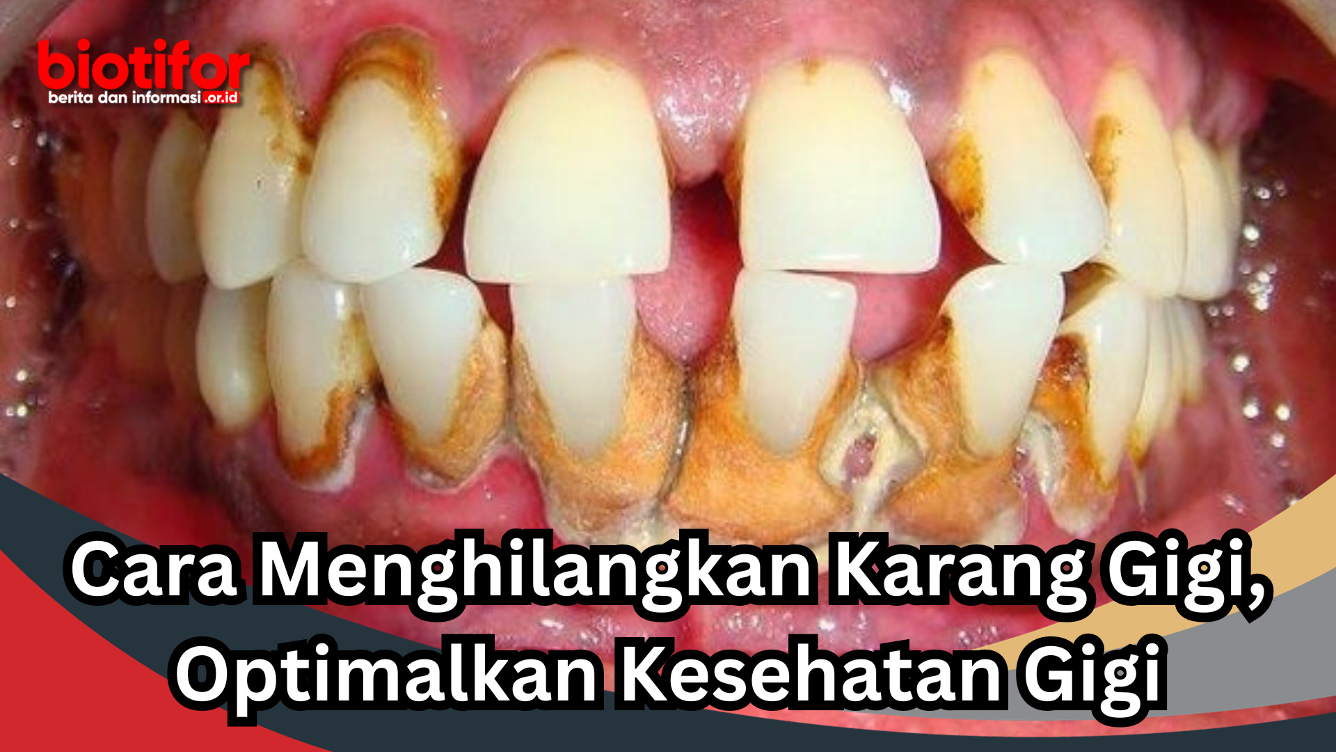 Cara Menghilangkan Karang Gigi, Optimalkan Kesehatan Gigi