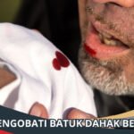 Cara Mengobati Batuk Dahak Berdarah