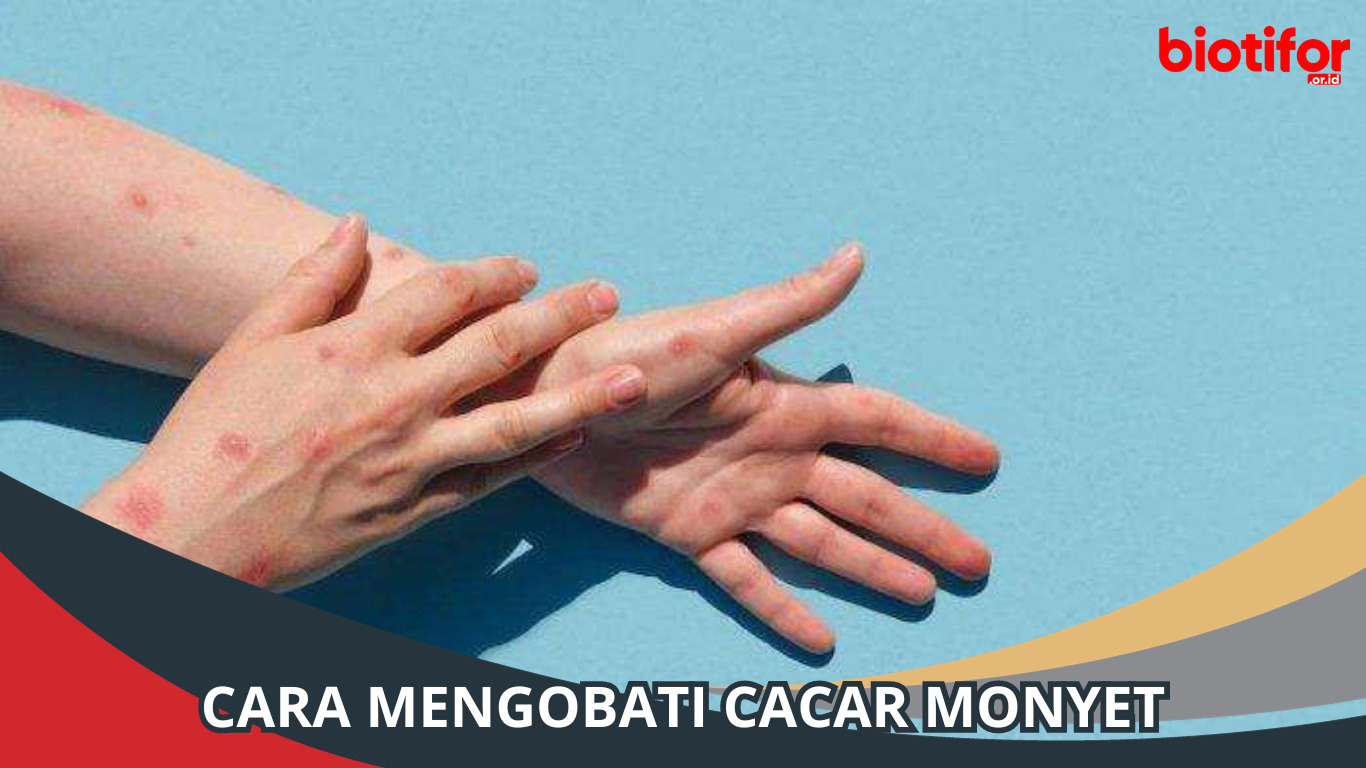 Cara Mengobati Cacar Monyet: Panduan Lengkap