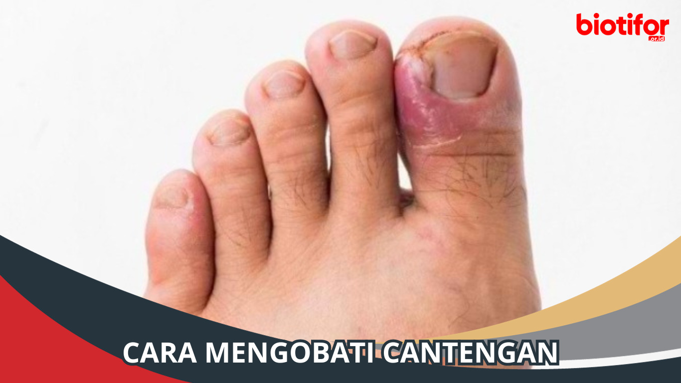 Cara Mengobati Cantengan : Solusi Kuku yang Infeksi