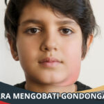 Cara Mengobati Gondongan