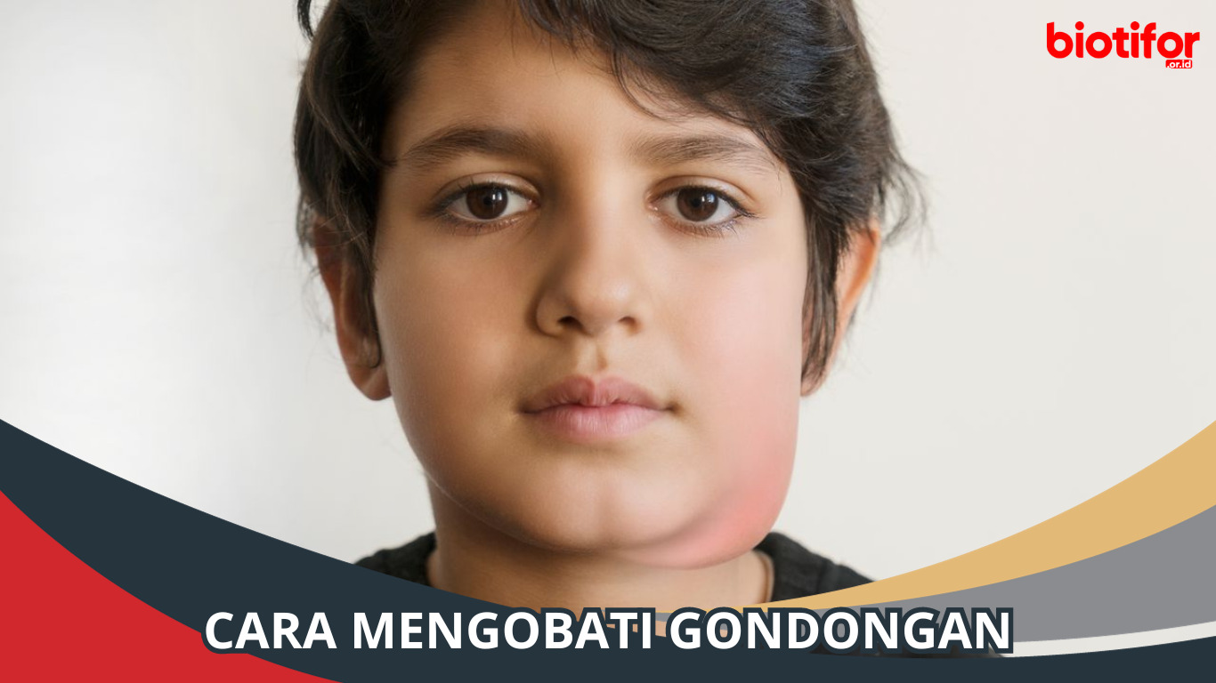 Cara Mengobati Gondongan dengan Cepat dan Mudah