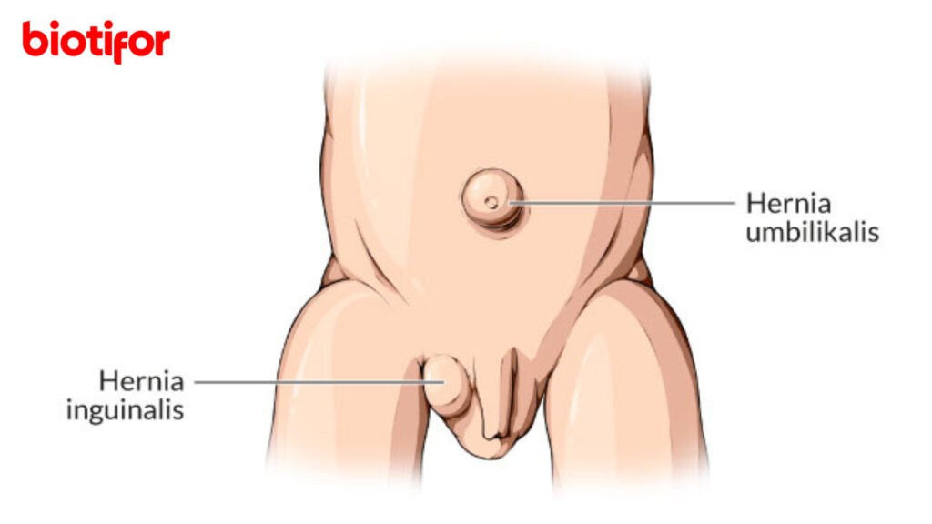 Cara Mengobati Hernia dengan Daun Sirih