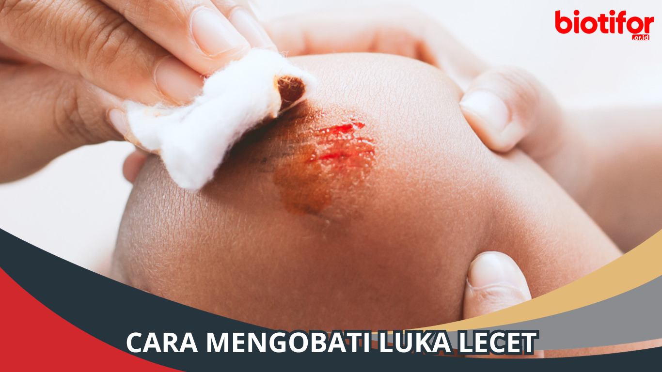 Cara Mengobati Luka Lecet, Untuk Meredakan Rasa Sakit