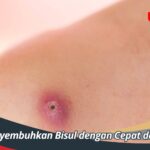 Cara Menyembuhkan Bisul dengan Cepat dan Efektif