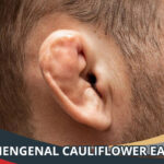 Cauliflower Ear